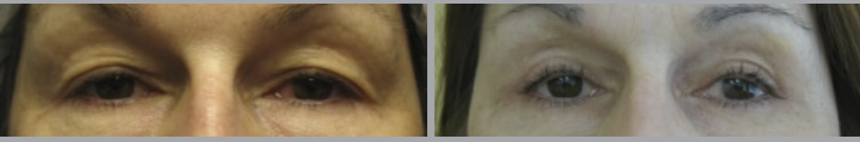 Eyelid Surgery or Blepharoplasty in Ventura, CA